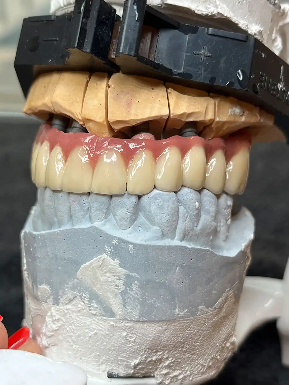 implantátumos fogsor 2