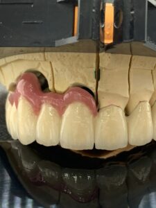 implantátumon és saját pilléren rögzülő híd