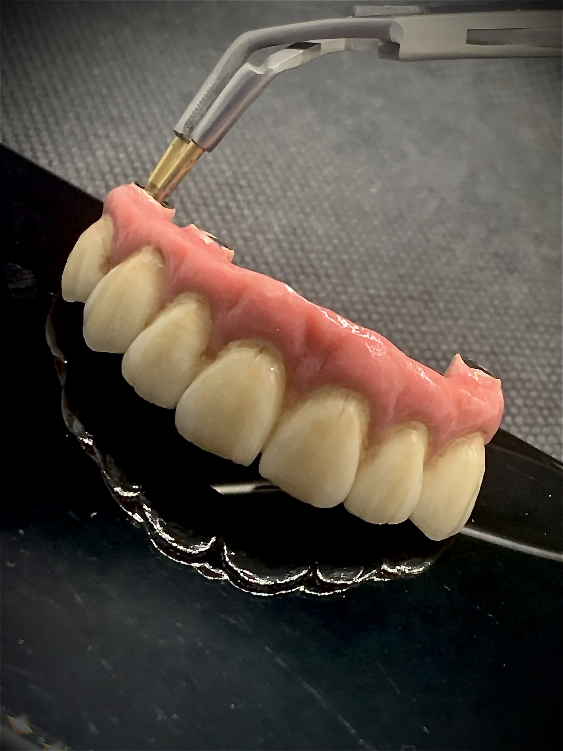 implantátumon rögzülő front híd