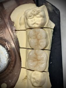 EMAX préskerámia overlay betét 2