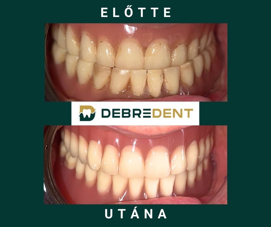 Kivehető fogsor, előtte-utána